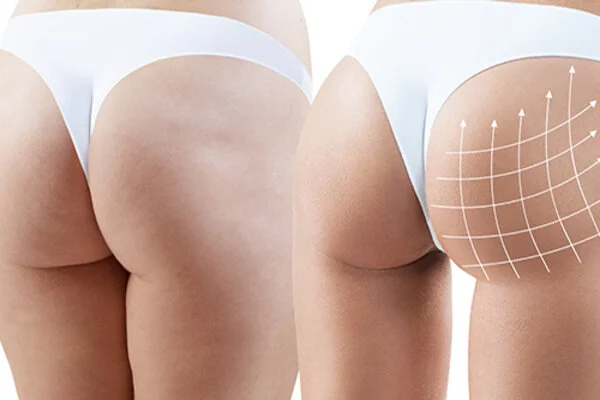 Brazilian Butt Lift Before and After in Riyadh