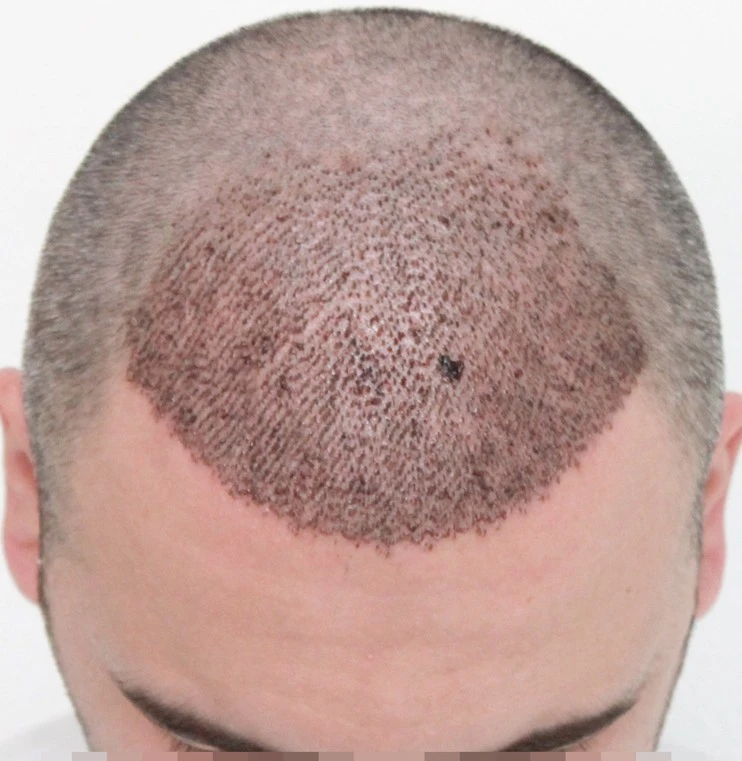 DHI Direct Hair Implant in Riyadh