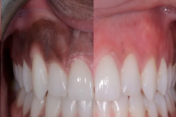 Gum depigmentation in Riyadh Before & After Results