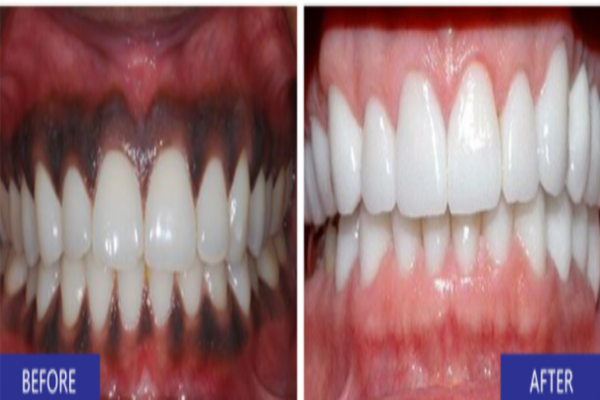 Gum depigmentation in Riyadh Results Before & After