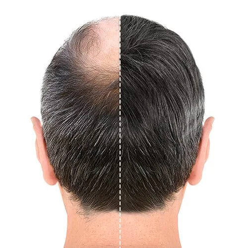 Hair Replacement before after in Riyadh