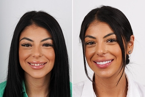 Hollywood Smile Makeover in Riyadh Before After