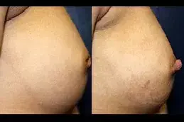 Inverted Nipple Surgery before after in Riyadh