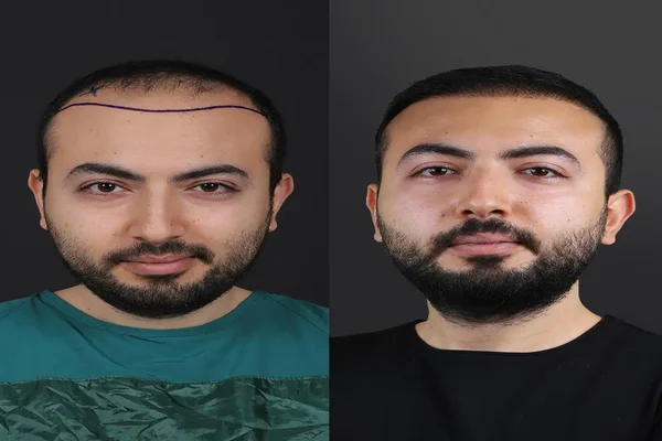 Male Hair Transplant In Riyadh Before & After Result