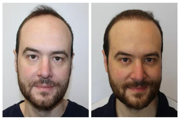 Male Hair Transplant In Riyadh Results Before & After