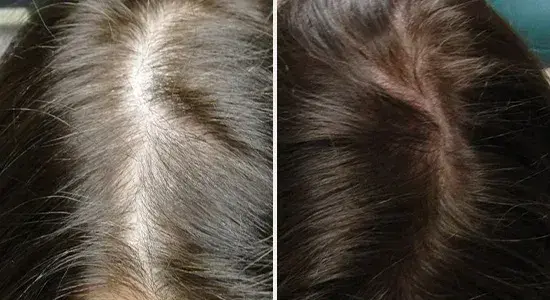 Acell Injections for Hair Growth before After Results