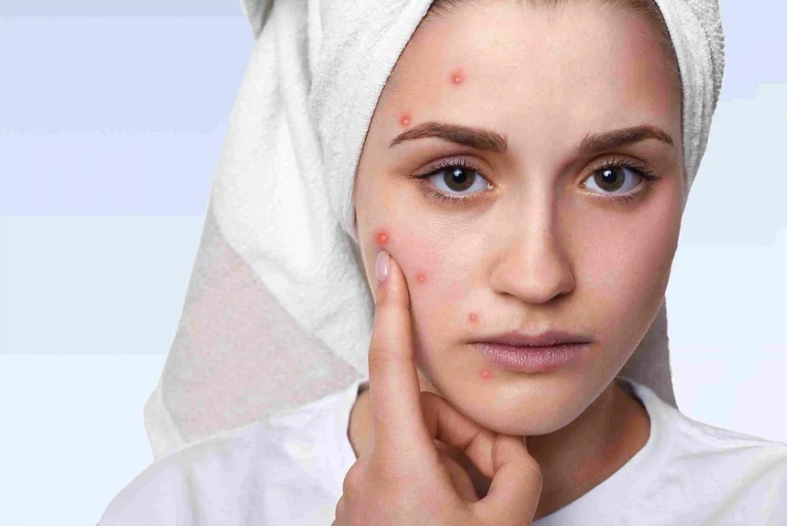 Acne Treatment in Riyadh