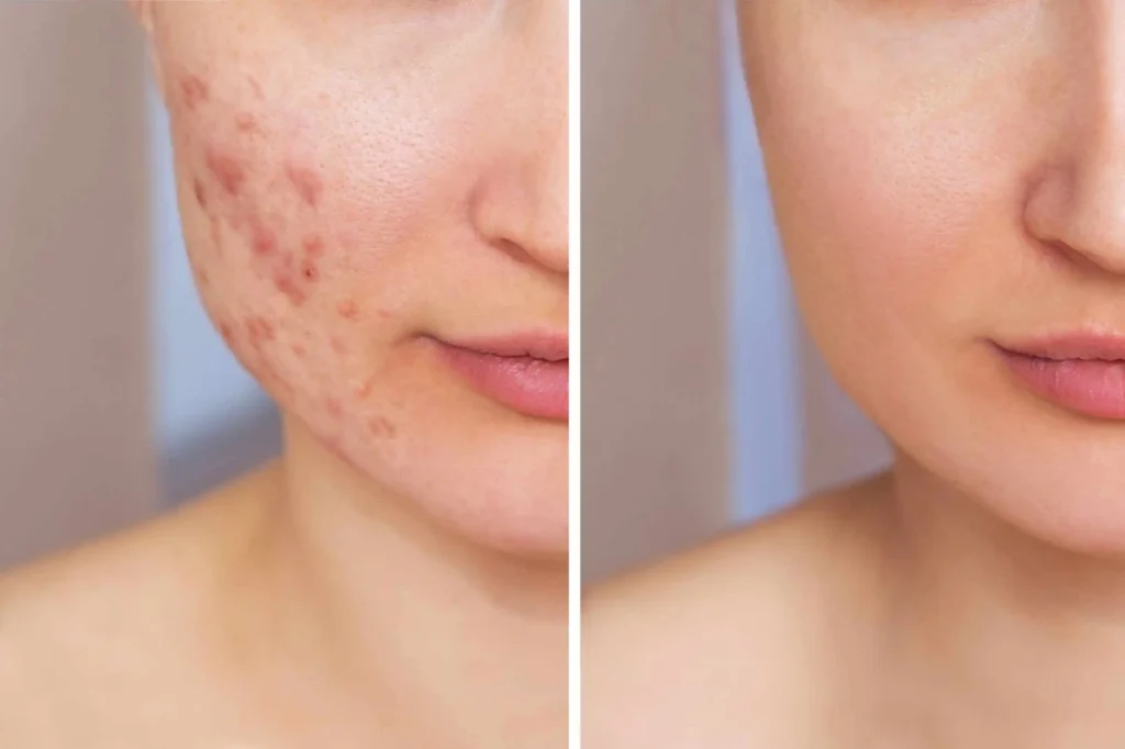 Acne treatment Before after results