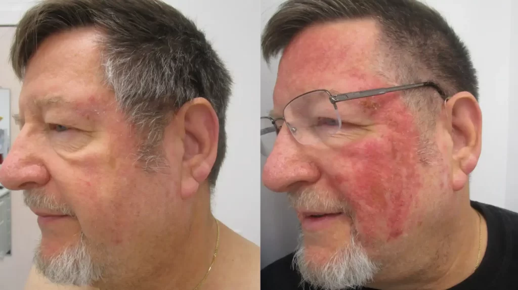 Actinic Keratosis Treatment in Riyadh Before After Results