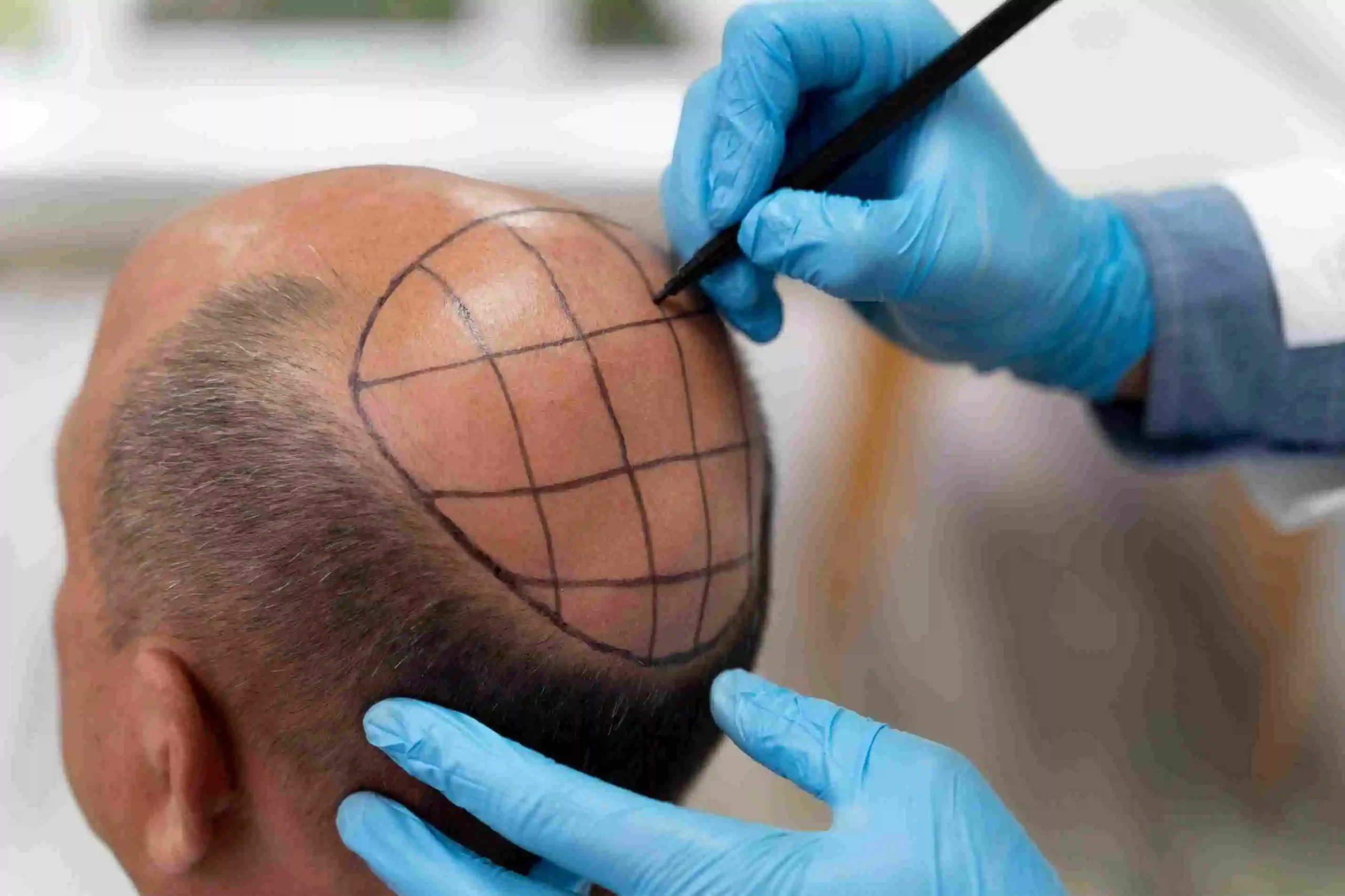 Crown Hair Transplant in Riyadh