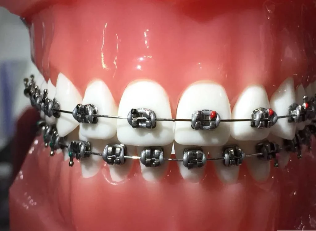 Dental Fixed Appliances Treatment Procedure