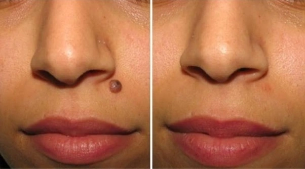 Dermascopy Mole Evaluation Before After Results