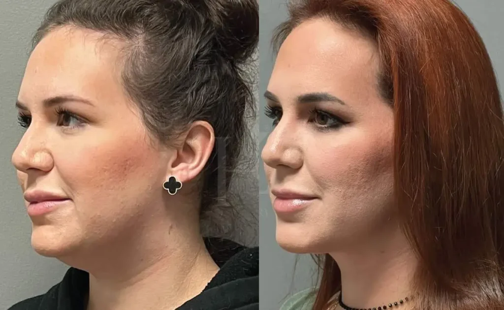 Double Chin Liposuction Before After