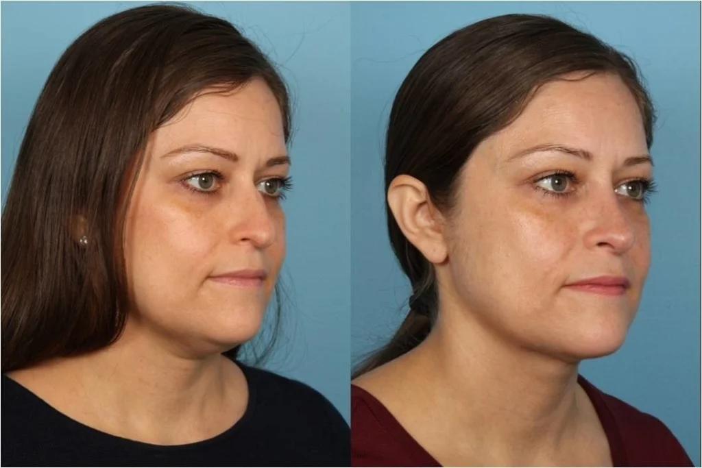 Double Chin Liposuction Before After Results
