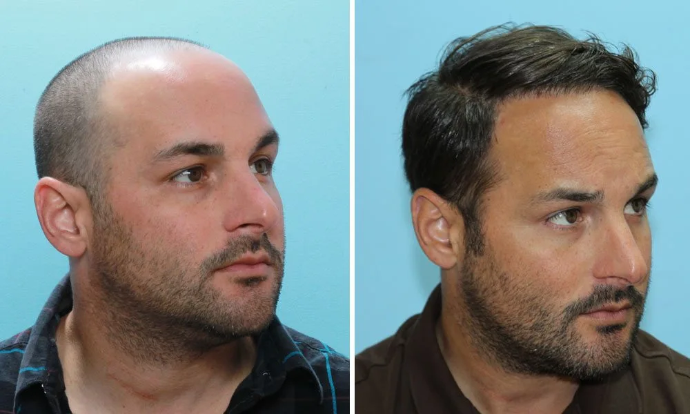 Hair Implants beffore after in Riyadh