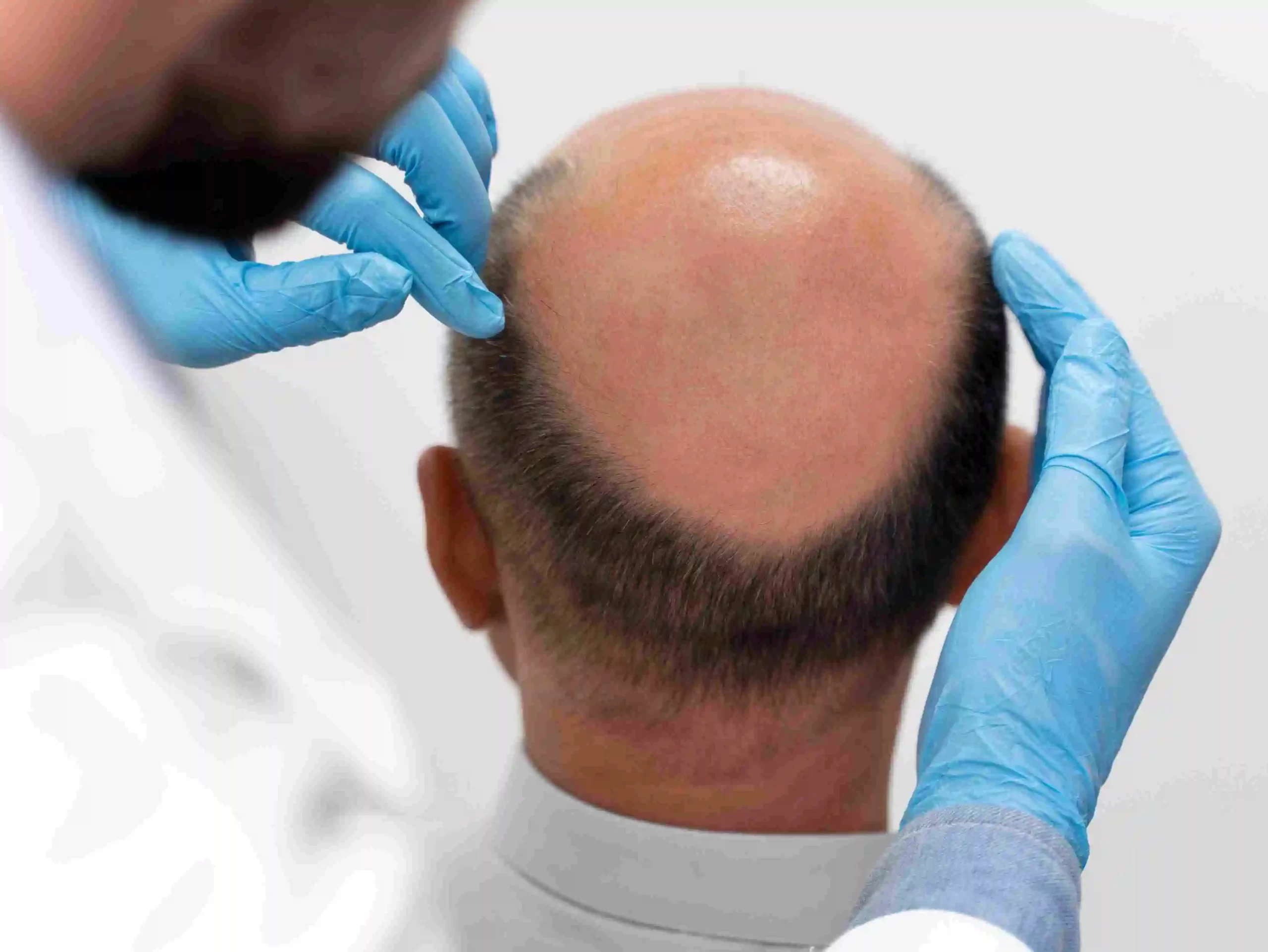 Hair Restoration Cost In Riyadh