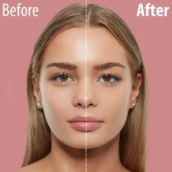 Hyaluronic Acid Before After Results