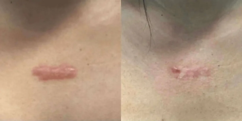 Keloid Treatment Before AFter