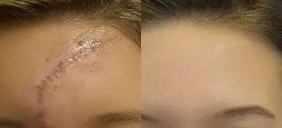 Keloid Treatment Before After Results