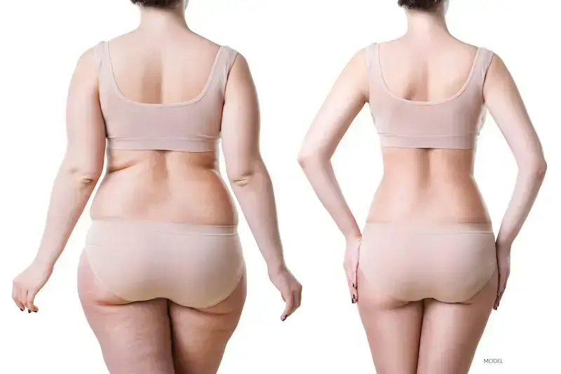 Laser Fat reduction Before After Results