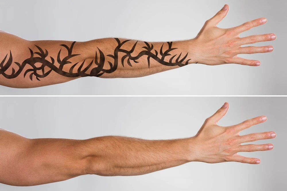 Laser Tattoo removal before after