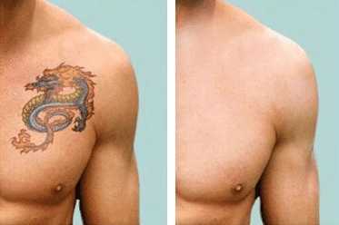 Laser tattoo removal before after results