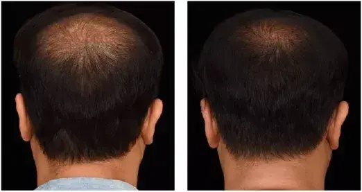 PRP Hair treatment Before After Results