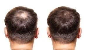 PRP Hair treatment Before After
