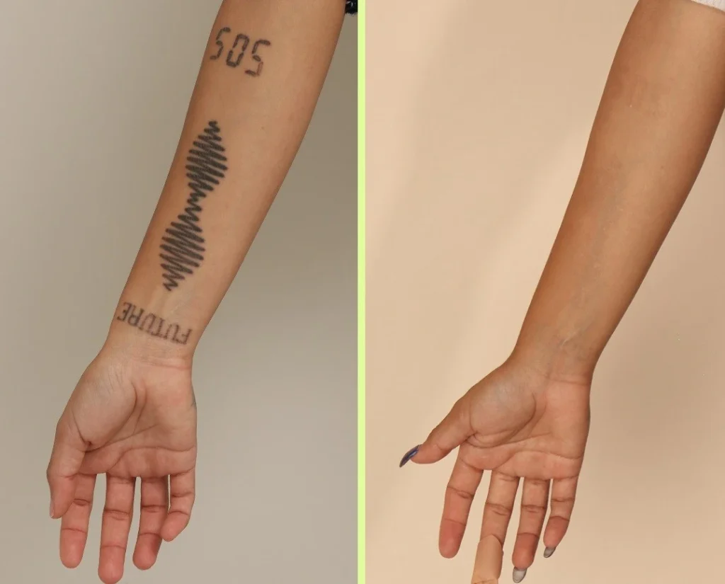 Picosure laser tattoo removal before after