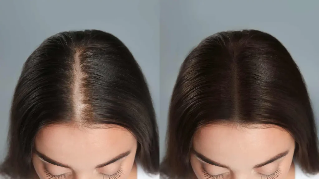 Regenera Actica Before After Results