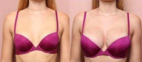 Saline Breast Implant Before After Results in Riyadh
