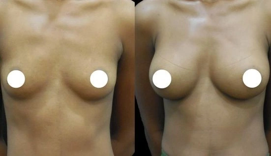 Short scar breast augmentation before after results