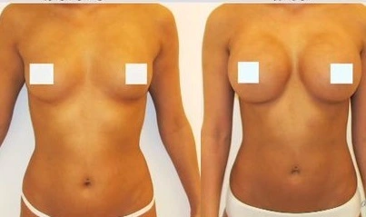 Short scar breast augmentation before after
