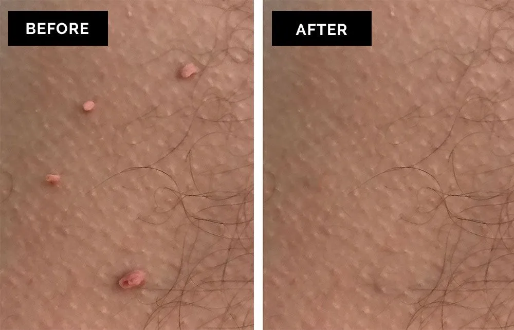 Skin Tag Removal Before After Results