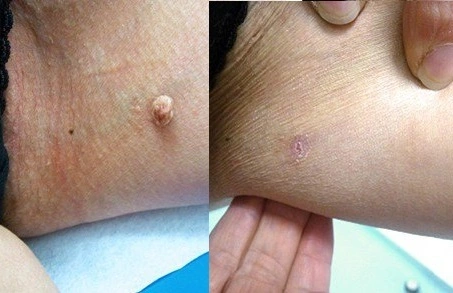 Skin Tag Removal Brfore After Results in Riyadh