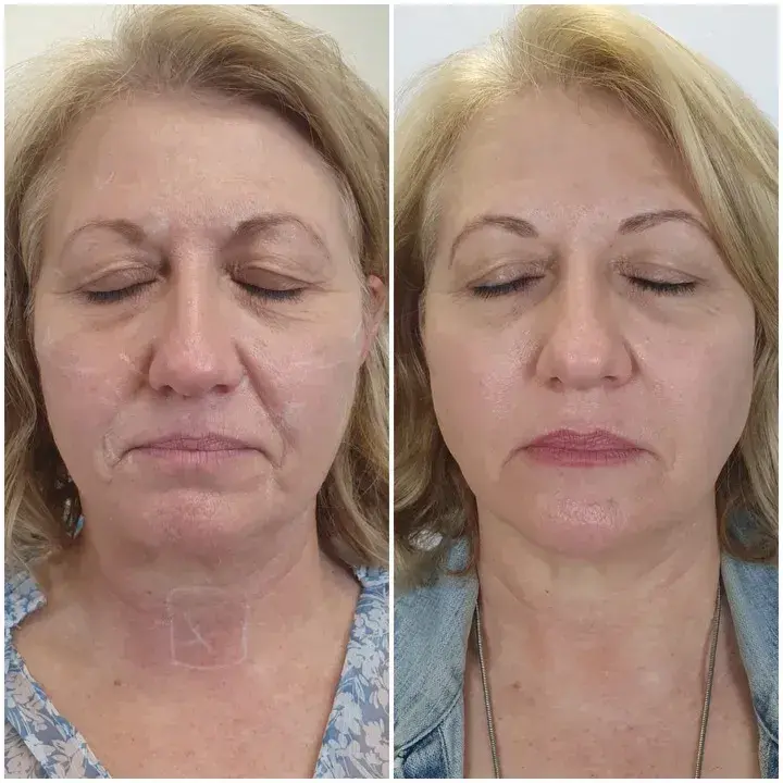 Skin Tightning and Body Contouring Before After Results