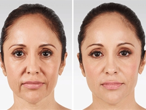 Skin Tightning and body Contouring Before AFter