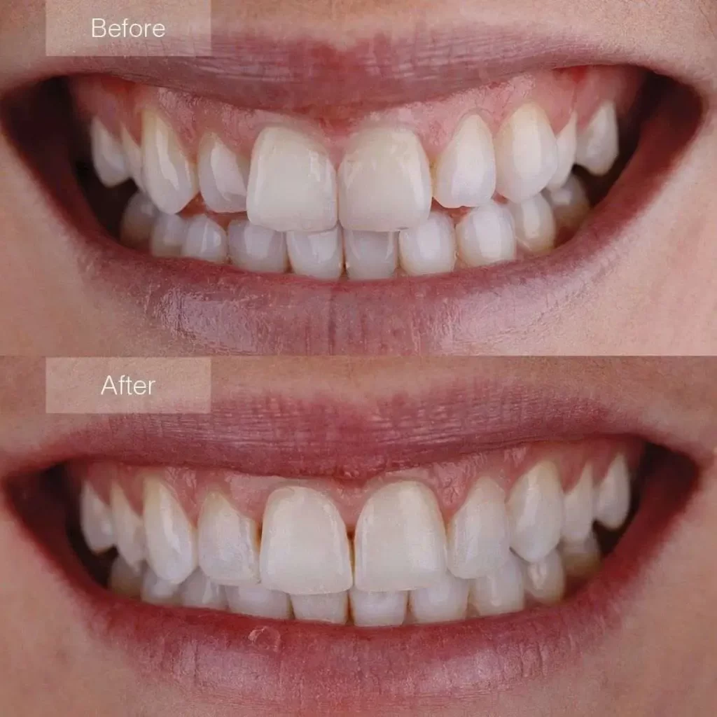 Teeth Overlapping Before After Results