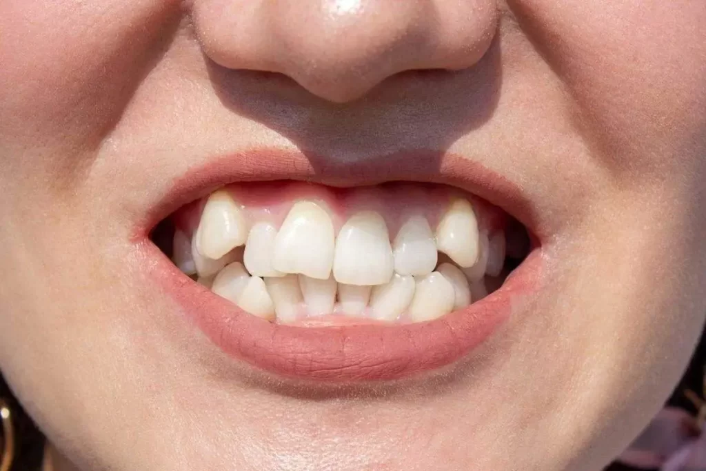 Teeth Overlapping Procedure