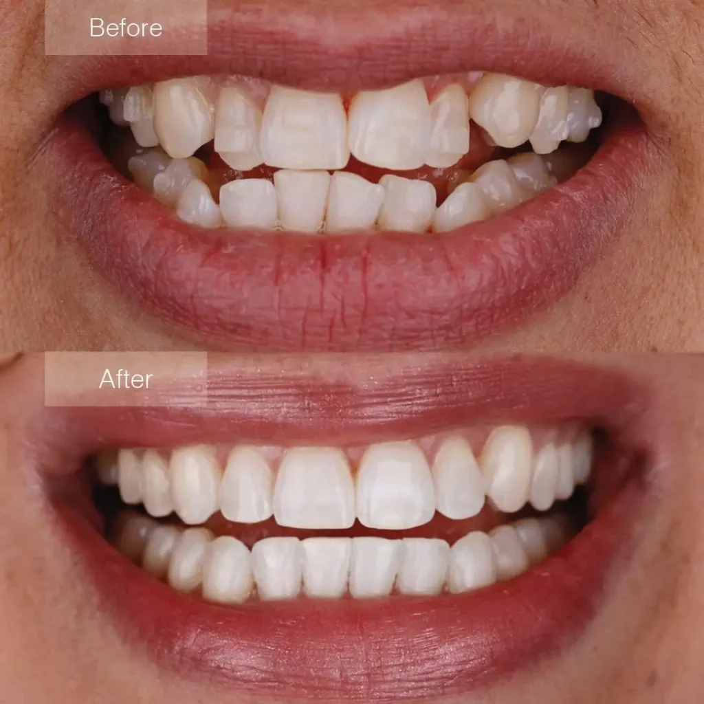 Teeth Straightening Alignment