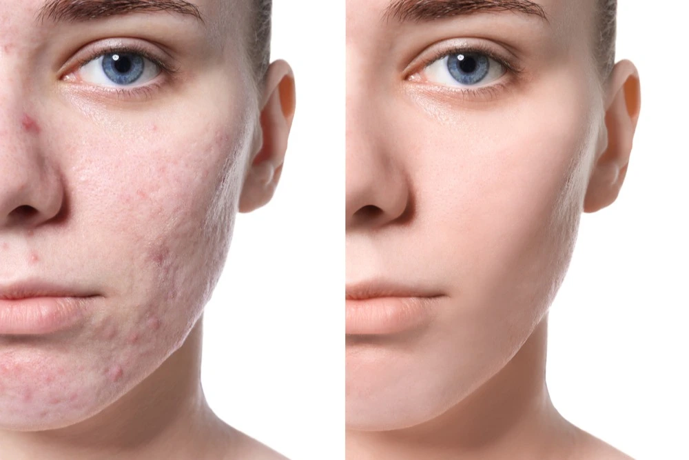 acne treatment before after