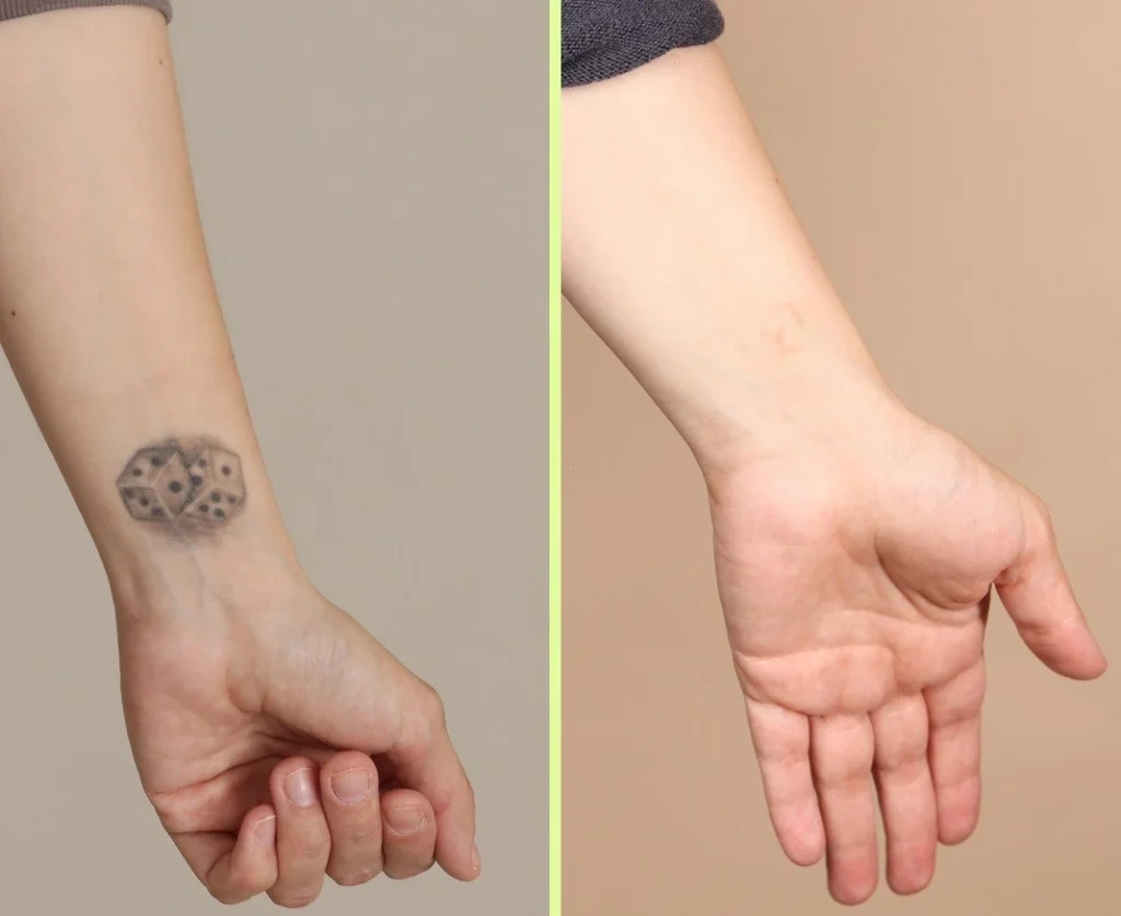 picosure laser tatttoo removal before after rsults