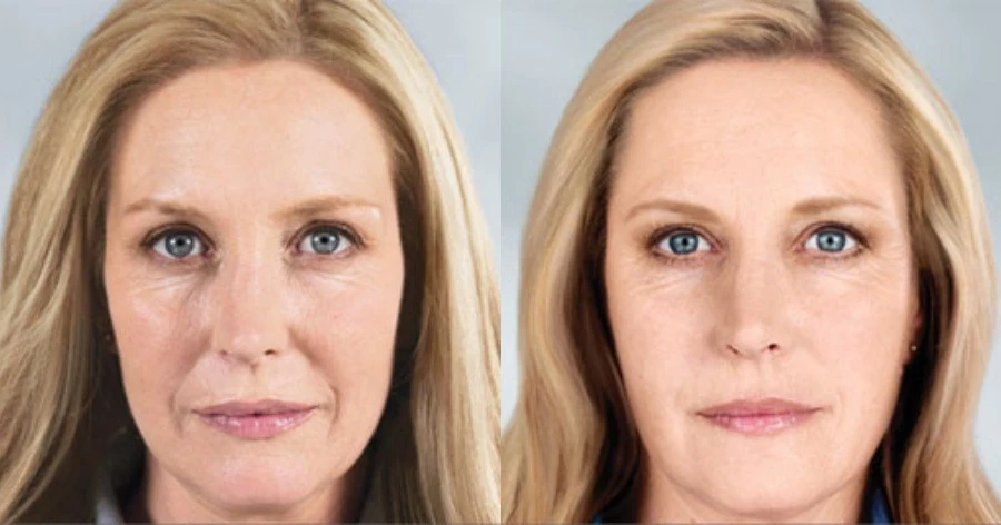 Anti aging tretrament Before After Results