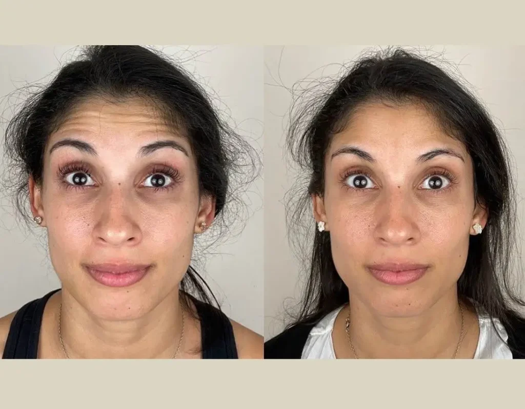 Botox Injections Before After Results in Riyadh