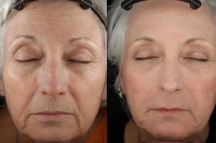 Fractional RF MICRONEEDLING bEFORE aFTER rESULTS