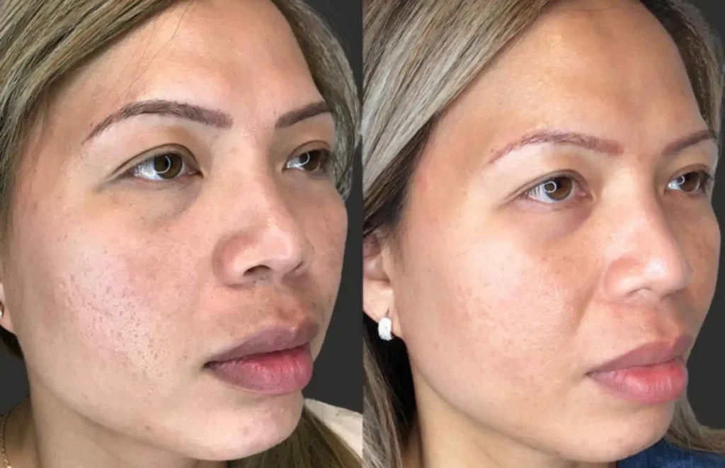 Fractional Rf microneedling Before After