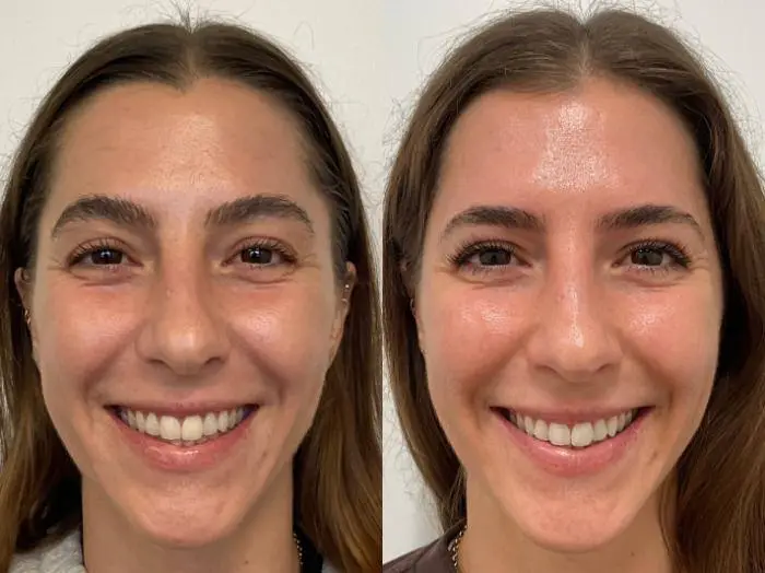 Halo Treatment Before After