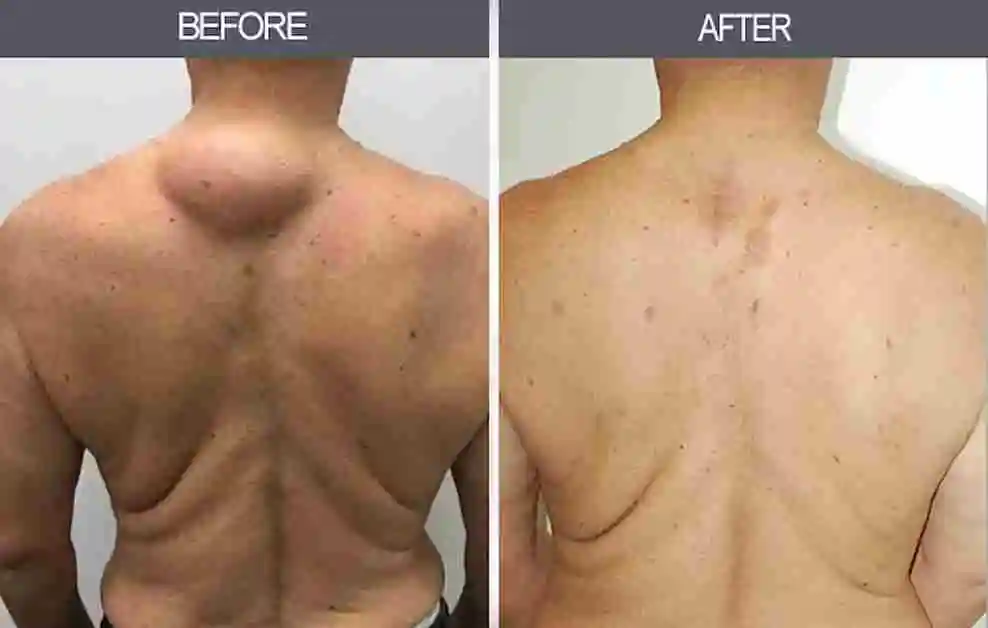 Lipoma Treatment Before After Results