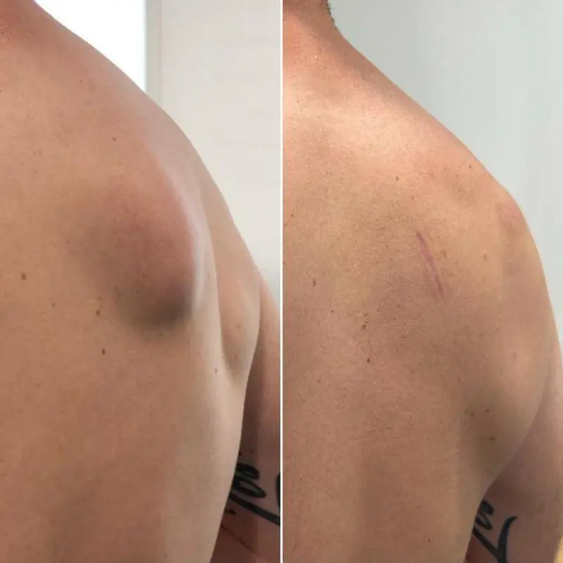 Lipoma Treatment Before After