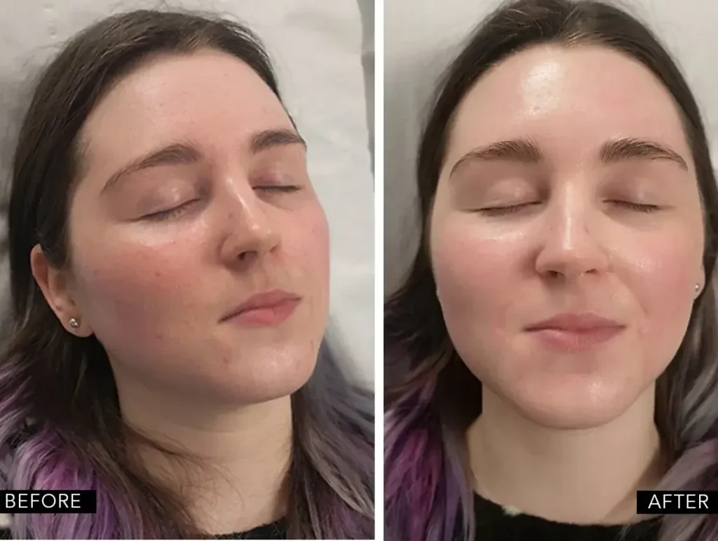 Mesotherapy before after results